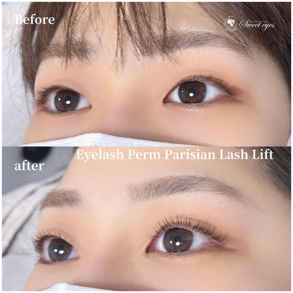 施術前と後では全然違います写真映りがとてもいいので気に入っています